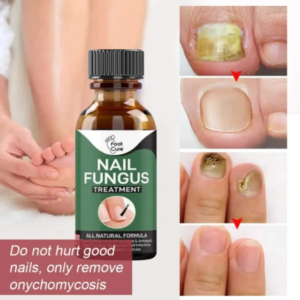 nail fungal treatment serum 10ml – anti fungal nail repair essence for damaged, cracked, discolored nails